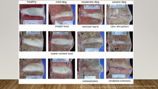 Galbusera F, van Rijsbergen M, Ito K, Huyghe JM, Brayda-Bruno M, Wilke HJ. Ageing and degenerative changes of the intervertebral disc and
their impact on spinal flexibility. Eur Spine J. Published online January 31, 2014.
 
