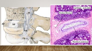 Galbusera F, van Rijsbergen M, Ito K, Huyghe JM, Brayda-Bruno M, Wilke HJ. Ageing and degenerative changes of the intervertebral disc and
their impact on spinal flexibility. Eur Spine J. Published online January 31, 2014.
Oichi T, Taniguchi Y, Oshima Y, Tanaka S, Saito T. Pathomechanism of intervertebral disc degeneration. JOR Spine. 2020;3(1):e1076.
 