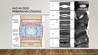 H2O IN DDD
PFIRRMANN STAGING
Farshad-Amacker NA, Farshad M, Winklehner A, Andreisek G. MR imaging of degenerative disc disease. Eur J Radiol. 2015;84(9):1768-1776.
 