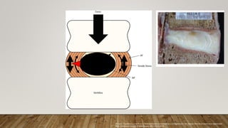 Kirnaz S, Capadona C, Lintz M, et al. Pathomechanism and biomechanics of degenerative disc disease: features of healthy and degenerated
discs. International Journal of Spine Surgery. 2021;15(s1):10-25.
 