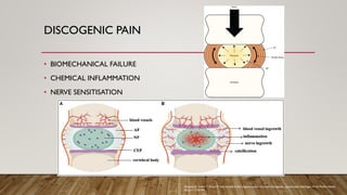 DISCOGENIC PAIN
• BIOMECHANICAL FAILURE
• CHEMICAL INFLAMMATION
• NERVE SENSITISATION
Samanta A, Lufkin T, Kraus P. Intervertebral disc degeneration—Current therapeutic options and challenges. Front Public Health.
2023;11:1156749.
 
