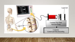 PROVOCATIVE DISCOGRAPHY
• The only confirmative test of
discogenic pain
• Lindgren from Scandinavia :1st
puncture of normal intervertebral
disc for diagnostic purposes in 1941
• Positive pain when PSI<50
Tomecek, FJ; Anthony, CS; Boxell, C; Warren, J. "Discography Interpretation and Techniques in the Lumbar Spine". Medscape. Archived from
the original on 3 April 2017. Retrieved 30 May 2022.
By BruceBlaus - Own work, CC BY-SA 4.0, https://commons.wikimedia.org/w/index.php?curid=44899518
Jain A, Jain S, Barasker SK, Agrawal A. Predictors of discogenic pain in magnetic resonance imaging: a retrospective study of provocative
 