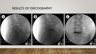 RESULTS OF DISCOGRAPHY
Jain A, Jain S, Barasker SK, Agrawal A. Predictors of discogenic pain in magnetic resonance imaging: a retrospective study of provocative
discography performed by posterolateral approach. The Korean Journal of Pain. 2021;34(4):447-453.
 