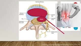 Korn, M., Khan, D. (2022). NoncancerPain: Discogenic Low Back Pain. In: Banik, R.K. (eds) Anesthesiology In-Training
Exam Review. Springer, Cham. https://doi.org/10.1007/978-3-030-87266-3_46
PAIN
 
