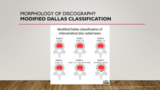 MORPHOLOGY OF DISCOGRAPHY
MODIFIED DALLAS CLASSIFICATION
Hacking C, Sharma R, Modified Dallas discographic classification of intervertebral disc radial tears. Reference article,
Radiopaedia.org (Accessed on 08 Jul 2025) https://doi.org/10.53347/rID-191354
 