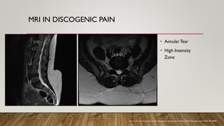 MRI IN DISCOGENIC PAIN
• AnnularTear
• High Intensity
Zone
Ajayi O, Annular fissure. Case study, Radiopaedia.org (Accessed on 09 Jul 2025) https://doi.org/10.53347/rID-82892
 