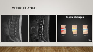 MODIC CHANGE
Teixeira A, Modic type I changes. Case study, Radiopaedia.org (Accessed on 09 Jul 2025) https://doi.org/10.53347/rID-23403
 