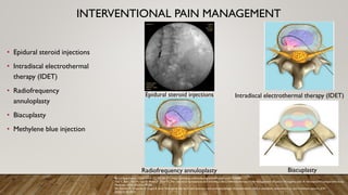 INTERVENTIONAL PAIN MANAGEMENT
• Epidural steroid injections
• Intradiscal electrothermal
therapy (IDET)
• Radiofrequency
annuloplasty
• Biacuplasty
• Methylene blue injection
Intradiscal electrothermal therapy (IDET)
Radiofrequency annuloplasty Biacuplasty
By Lucdesaulniers - Own work, CC BY-SA 3.0, https://commons.wikimedia.org/w/index.php?curid=2936888
Yoo Y, Bae J, Kim H, Lee H, Moon JY, Kim YC. Percutaneous nucleoplasty and intradiscal electrothermal therapy in the management of lumbar discogenic pain: A retrospective comparative study.
Medicine. 2024;103(32):e39230.
De Simone M, Choucha A, Ciaglia E, et al. Discogenic low back pain: anatomic and pathophysiologic characterization, clinical evaluation, biomarkers, ai, and treatment options. JCM.
2024;13(19):5915.
Epidural steroid injections
 