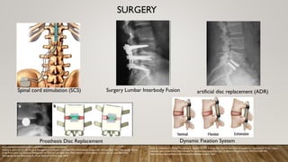 SURGERY
https://www.jamesstephensdo.com/service/spinal-cord-stimulation
Mathur S, Jenis LG, An HS: Surgical Management of Chronic Low Back Pain: Arthrodesis, in Jenis LG, ed: Low Back Pain: Monograph Series.
(Left) From Jenis LG: Surgical Management of Chronic Low Back Pain: Alternatives to Arthrodesis, in Jenis LG, ed: Low Back Pain:
Monograph Series. Rosemont, IL, Amer Acad of Orthop Surg, 2005.
Spinal cord stimulation (SCS) Surgery Lumbar Interbody Fusion
Prosthesis Disc Replacement
artificial disc replacement (ADR)
Dynamic Fixation System
Sacks G, DeStefano V, Parker C, Lebens R, Mushlin H. The artificial disc nucleus and other strategies for replacement of the nucleus
pulposus: past, present and future designs for an emerging surgical solution. Engineered Regeneration. 2024;5(2):269-281.
https://www.surgeryplanet.com/orthopaedics/dynesys-surgery.html
 