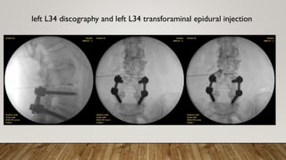left L34 discography and left L34 transforaminal epidural injection
 