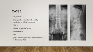 CASE 2
• 65 y/o male
• back pain for 3 months with both leg
numbness w/ right predominant
• VAS 3
• Unable to walk for 20 min
• claudication +
• PH:
• post Lumbar surgery L3-4-5 laminectomy,L4-
5 diskectomy 2022
 