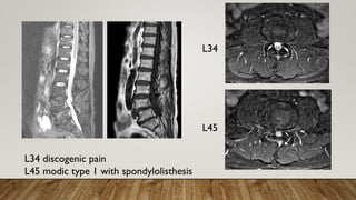L34
L45
L34 discogenic pain
L45 modic type 1 with spondylolisthesis
 