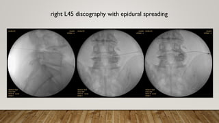 right L45 discography with epidural spreading
 