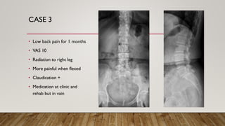 CASE 3
• Low back pain for 1 months
• VAS 10
• Radiation to right leg
• More painful when flexed
• Claudication +
• Medication at clinic and
rehab but in vain
 