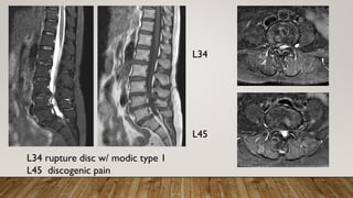 L34
L45
L34 rupture disc w/ modic type 1
L45 discogenic pain
 