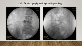 Left L34 discography with epidural spreading
 