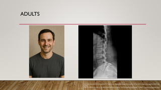 ADULTS
Yonso M, Spondylolisthesis (grade II). Case study, Radiopaedia.org (Accessed on 03 Jul 2025) https://doi.org/10.53347/rID-
22450
OpenAI. (2025). Portrait of an adult male smiling in a gray T-shirt [AI-generated image]. ChatGPT. https://chat.openai.com/
 