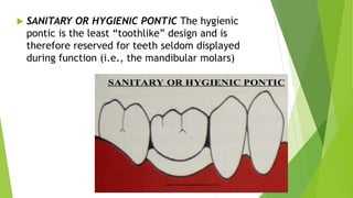 pontics in the prosthetic dentistry