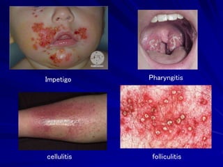 Scarlet fever-rash Pyoderma
Necrotizing fasciitis
 