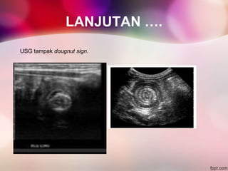 LANJUTAN ….
USG tampak dougnut sign.
 