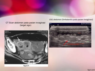 CT Scan abdomen pada pasien invaginasi
(target sign)
USG abdomen (limfadenitis pada pasien invaginasi)
 