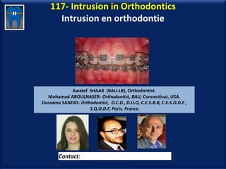 117- Intrusion in Orthodontics
Intrusion en orthodontie
Awatef SHAAR (BAU-LB), Orthodontist.
Mohamad ABOULNASER- Orthodontist, BAU, Connecticut, USA.
Oussama SANDID- Orthodontist, D.C.D., D.U.O, C.E.S.B.B, C.E.S.O.D.F ,
S.Q.O.D.F, Paris. France.
Contact: dr.aboualnaser@hotmail.com
www.orthofree.com
 