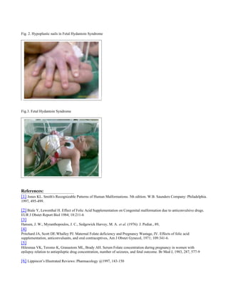 Fig. 2. Hypoplastic nails in Fetal Hydantoin Syndrome




Fig.3. Fetal Hydantoin Syndrome




References:
[1] Jones KL. Sm...