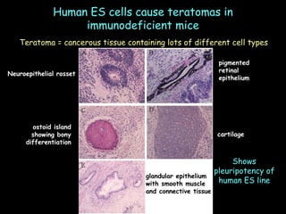 Human ES cells cause teratomas in immunodeficient mice Teratoma = cancerous tissue containing lots of different cell types glandular epithelium with smooth muscle and connective tissue Neuroepithelial rosset pigmented retinal epithelium ostoid island showing bony differentiation cartilage Shows pleuripotency of human ES line 
