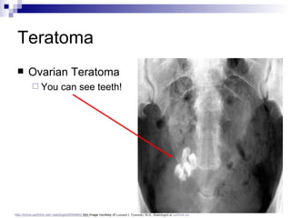 Teratoma Ovarian Teratoma You can see teeth! http://home.earthlink.net/~radiologist/ tf /040802. htm   Image courtesy of  Leonard J. Tyminski, M.D., Radiologist at  earthlink.net 