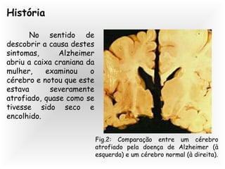 História
No sentido de
descobrir a causa destes
sintomas, Alzheimer
abriu a caixa craniana da
mulher, examinou o
cérebro e notou que este
estava severamente
atrofiado, quase como se
tivesse sido seco e
encolhido.
Fig.2: Comparação entre um cérebro
atrofiado pela doença de Alzheimer (à
esquerda) e um cérebro normal (à direita).
 