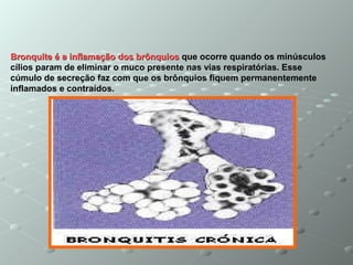 Bronquite é a inflamação dos brônquiosBronquite é a inflamação dos brônquios que ocorre quando os minúsculos
cílios param de eliminar o muco presente nas vias respiratórias. Esse
cúmulo de secreção faz com que os brônquios fiquem permanentemente
inflamados e contraídos.
 