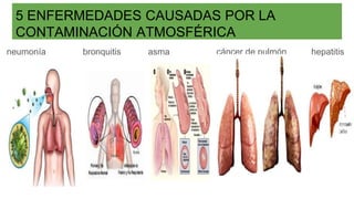 5 ENFERMEDADES CAUSADAS POR LA
CONTAMINACIÓN ATMOSFÉRICA
neumonía bronquitis asma cáncer de pulmón hepatitis
 