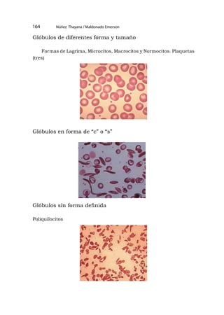 Núñez Thayana / Maldonado Emerson
164
Glóbulos de diferentes forma y tamaño
Formas de Lagrima, Microcitos, Macrocitos y Normocitos. Plaquetas
(tres)
Glóbulos en forma de “c” o “s”
Glóbulos sin forma definida
Poliquilocitos
 