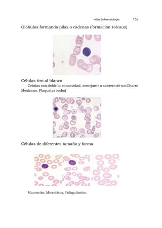 Glóbulos formando pilas o cadenas (formación roleaux)
Células tiro al blanco
Celulas con doble bi-concavidad, semejante a sobrero de un Charro
Mexicano. Plaquetas (ocho)
Células de diferentes tamaño y forma
Macrocito, Microcitos, Poliquilocito.
Atlas de hematología 165
 