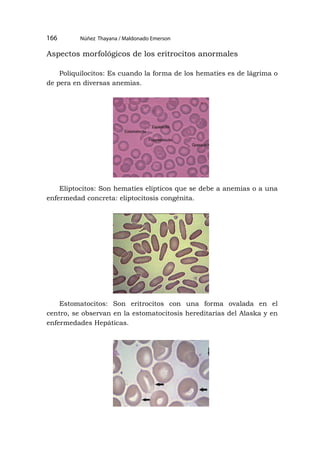 Núñez Thayana / Maldonado Emerson
166
Aspectos morfológicos de los eritrocitos anormales
Poliquilocitos: Es cuando la forma de los hematíes es de lágrima o
de pera en diversas anemias.
Eliptocitos: Son hematíes elípticos que se debe a anemias o a una
enfermedad concreta: eliptocitosis congénita.
Estomatocitos: Son eritrocitos con una forma ovalada en el
centro, se observan en la estomatocitosis hereditarias del Alaska y en
enfermedades Hepáticas.
 