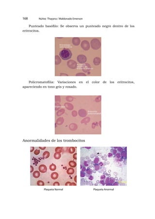 Núñez Thayana / Maldonado Emerson
168
Punteado basófilo: Se observa un punteado negro dentro de los
eritrocitos.
Policromatofilia: Variaciones en el color de los eritrocitos,
apareciendo en tono gris y rosado.
Plaqueta Normal Plaqueta Anormal
Anormalidades de los trombocitos
 
