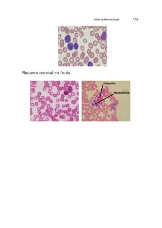 Atlas de hematología 169
Plaqueta normal en frotis
 