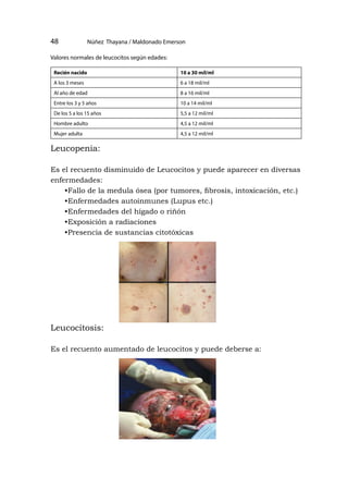 •
Núñez Thayana / Maldonado Emerson
48
Valores normales de leucocitos según edades:
Leucopenia:
Es el recuento disminuido de Leucocitos y puede aparecer en diversas
enfermedades:
•Fallo de la medula ósea (por tumores, fibrosis, intoxicación, etc.)
•Enfermedades autoinmunes (Lupus etc.)
•Enfermedades del hígado o riñón
•Exposición a radiaciones
•Presencia de sustancias citotóxicas
Leucocitosis:
Es el recuento aumentado de leucocitos y puede deberse a:
Recién nacido 10 a 30 mil/ml
A los 3 meses 6 a 18 mil/ml
Al año de edad 8 a 16 mil/ml
Entre los 3 y 5 años 10 a 14 mil/ml
De los 5 a los 15 años 5,5 a 12 mil/ml
Hombre adulto 4,5 a 12 mil/ml
Mujer adulta 4,5 a 12 mil/ml
 