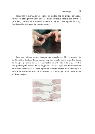 Hematología 69
Sostener el portaobjetos entre los dedos con la mano izquierda,
tomar el otro portaobjeto con la mano derecha deslizarlos sobre el
primero, realizar movimientos suaves sobre el portaobjetos de abajo
hacia arriba sin tocar la gota de sangre.
Las dos placas deben formar un ángulo de 30-45 grados de
inclinación. Deslizar hacia arriba la placa con la mano derecha, tocar
la sangre, permitir que por capilaridad se extienda a lo largo del filo
del portaobjeto formando un ángulo de 30-45 de grados de inclinación
deslizar suavemente el portaobjeto hacia abajo arrastrando la sangre, a
una velocidad constante sin levantar el portaobjetos, hasta tomar tocar
el dedo pulgar.
 