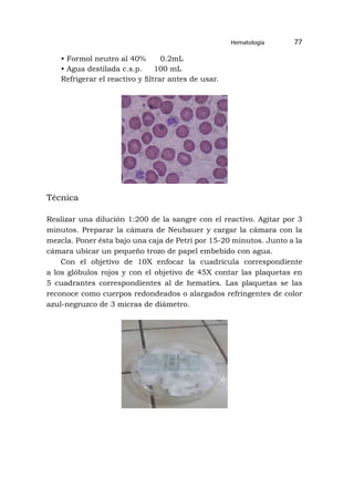 Hematología 77
• Formol neutro al 40% 0.2mL
• Agua destilada c.s.p. 100 mL
Refrigerar el reactivo y filtrar antes de usar.
Técnica
Realizar una dilución 1:200 de la sangre con el reactivo. Agitar por 3
minutos. Preparar la cámara de Neubauer y cargar la cámara con la
mezcla. Poner ésta bajo una caja de Petri por 15-20 minutos. Junto a la
cámara ubicar un pequeño trozo de papel embebido con agua.
Con el objetivo de 10X enfocar la cuadrícula correspondiente
a los glóbulos rojos y con el objetivo de 45X contar las plaquetas en
5 cuadrantes correspondientes al de hematíes. Las plaquetas se las
reconoce como cuerpos redondeados o alargados refringentes de color
azul-negruzco de 3 micras de diámetro.
 