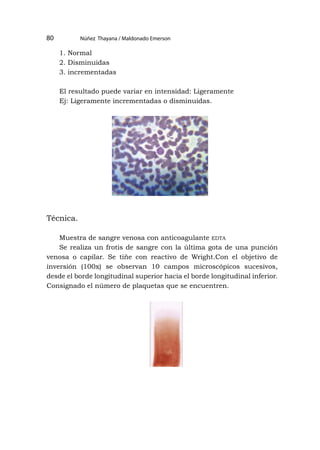 80
1. Normal
2. Disminuidas
3. incrementadas
El resultado puede variar en intensidad: Ligeramente
Ej: Ligeramente incrementadas o disminuidas.
Técnica.
Muestra de sangre venosa con anticoagulante edta
Se realiza un frotis de sangre con la última gota de una punción
venosa o capilar. Se tiñe con reactivo de Wright.Con el objetivo de
inversión (100x) se observan 10 campos microscópicos sucesivos,
desde el borde longitudinal superior hacia el borde longitudinal inferior.
Consignado el número de plaquetas que se encuentren.
Núñez Thayana / Maldonado Emerson
 