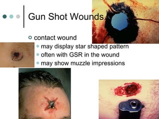 Gun Shot Wounds contact wound  may display star shaped pattern often with GSR in the wound may show muzzle impressions 