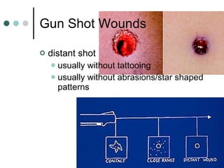 Gun Shot Wounds distant shot usually without tattooing  usually without abrasions/star shaped patterns 