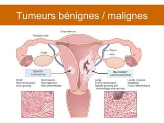 Tumeurs bénignes / malignes 
