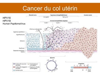 Cancer du col utérin HPV16 HPV18 Human PapillomaVirus 