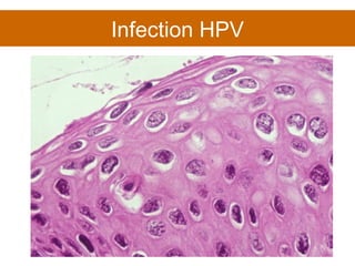 Infection HPV 