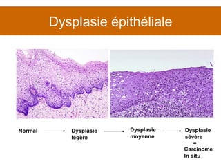 Dysplasie épithéliale Carcinome In situ = Normal Dysplasie légère Dysplasie moyenne Dysplasie sévère 