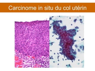 Carcinome in situ du col utérin 