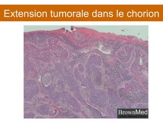 Extension tumorale dans le chorion 