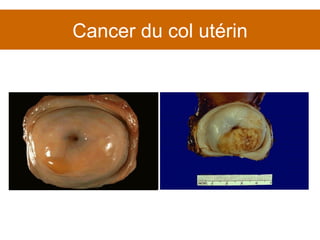 Cancer du col utérin 